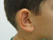 Intervention oreilles avant 1
