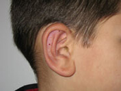 Intervention oreilles après 1